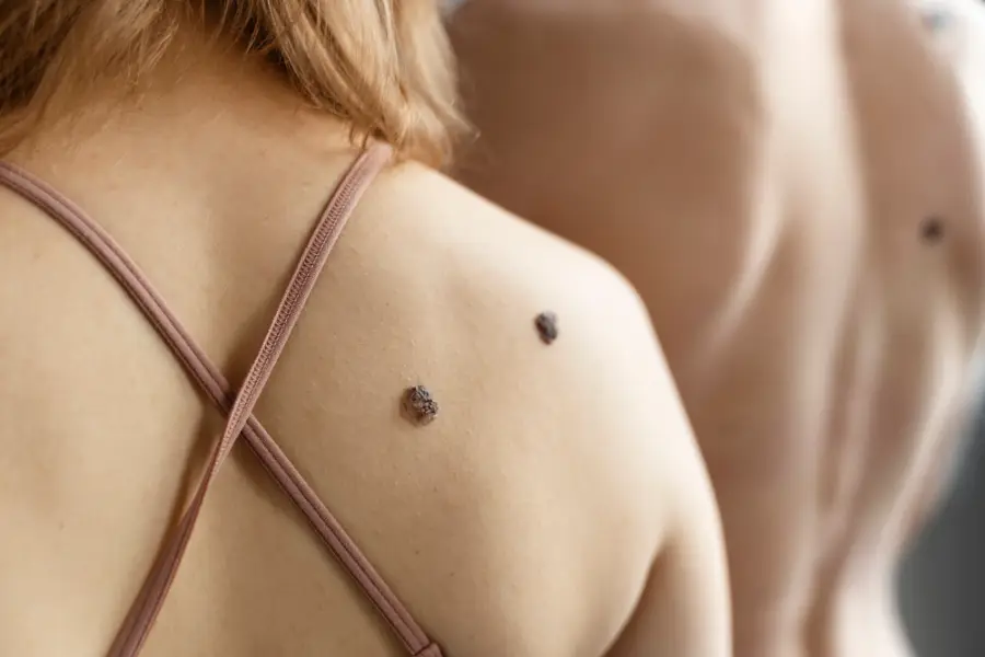 Young people with moles back view
